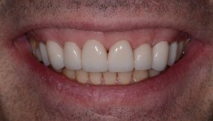 A Final smile zirconium crowns