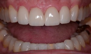 B after veneers and teeth whitening