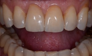 J after emax crowns