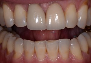 patient J before emax crowns