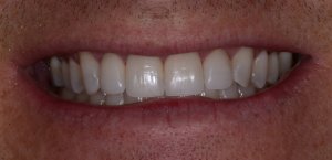 L after ceramic veneers