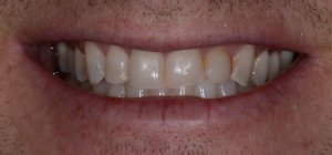 patient L before veneers