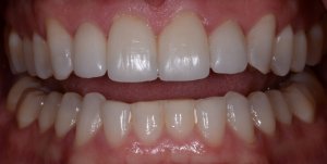 L1 after veneers