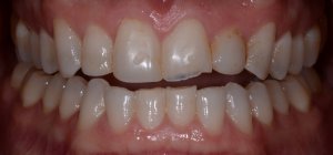 patient L1 before ceramic veneers