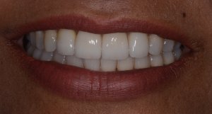 S after emax veneers