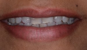 S before emax veneers