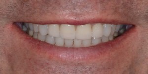 S1 after cermaic veneers