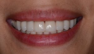 Y after emax crowns